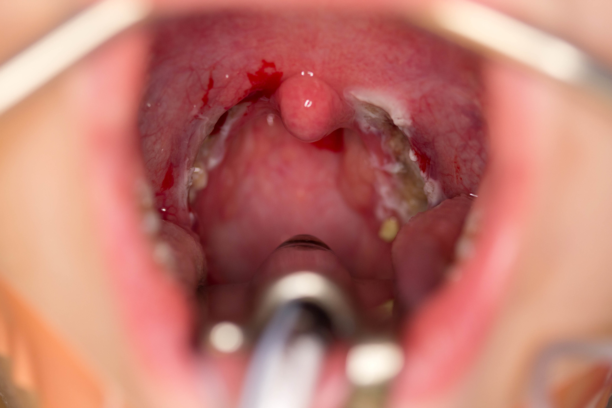 Tonsil removal surgery