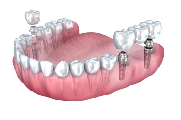 Get Dental Implant Liverpool And Make Yourself Attractive