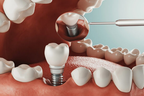 How You Can Pick A Dentist For Dental Implants