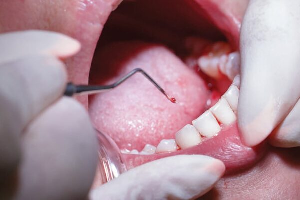 Why Do You Require Periodontal Treatment?