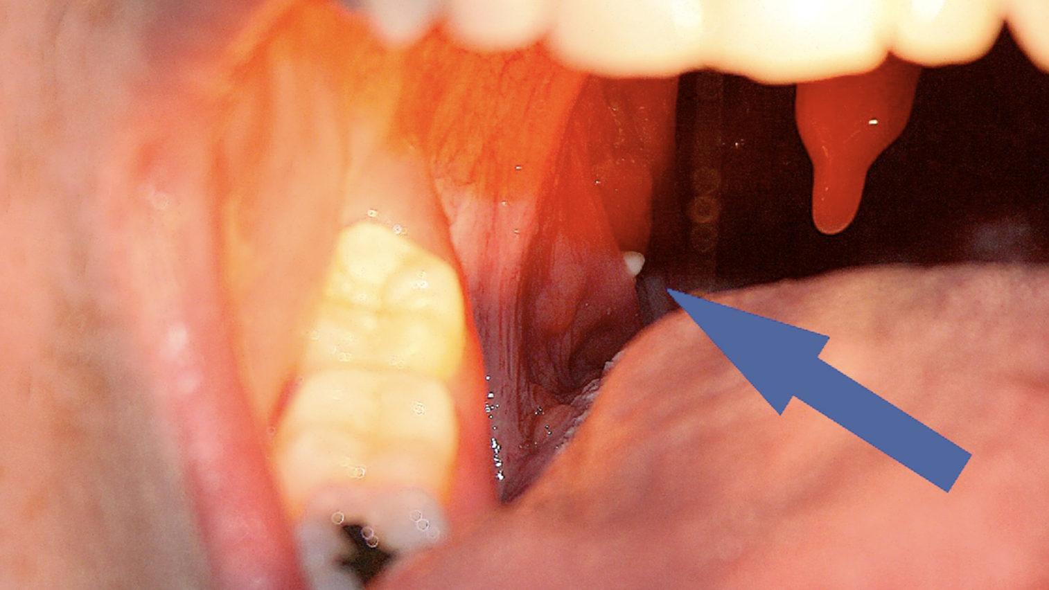 tonsil stone removal