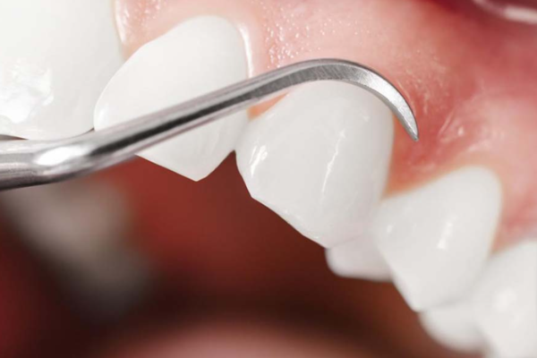 Simple Ways For Periodontal Disease Treatment