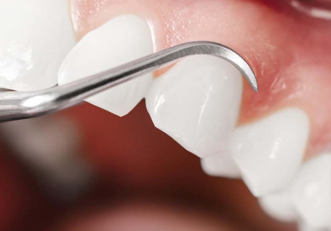 periodontal treatment