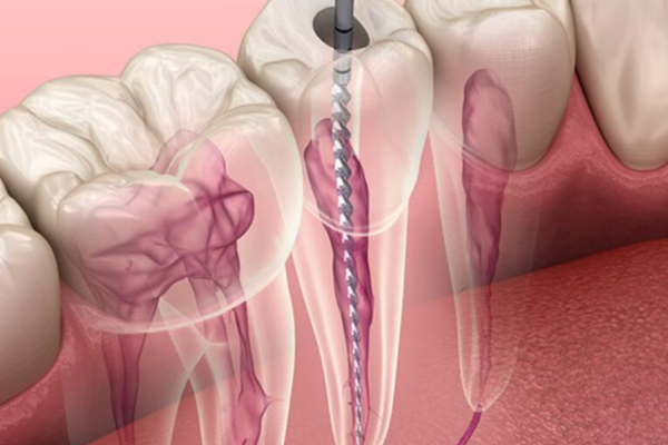 Picking Dentists For The Root Canal Treatment