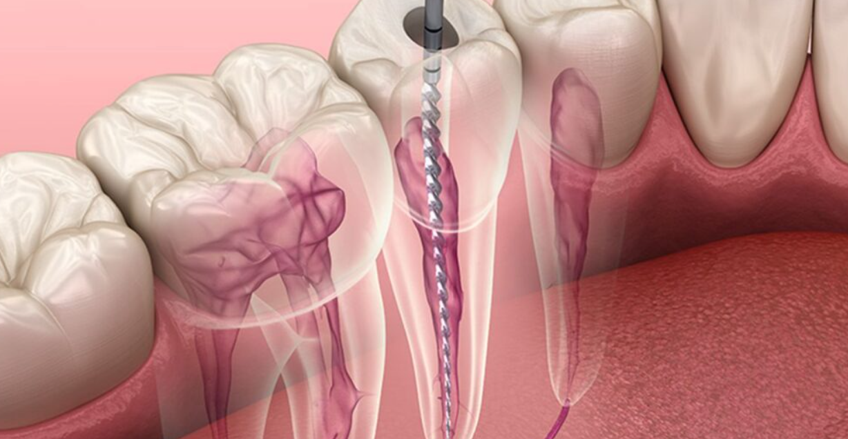 root canal treatment