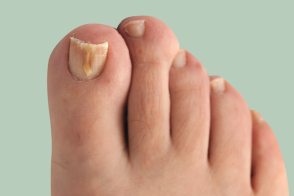 Types Of Fungal Nail Infection That Needs Anti-Fungal Nail Treatment