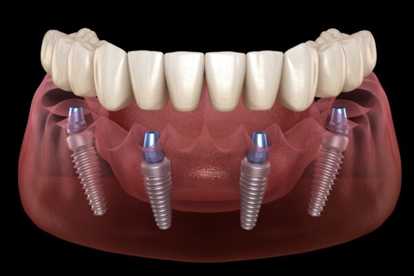 All-On-4 Liverpool – The Most Proficient Dental Implant Treatment