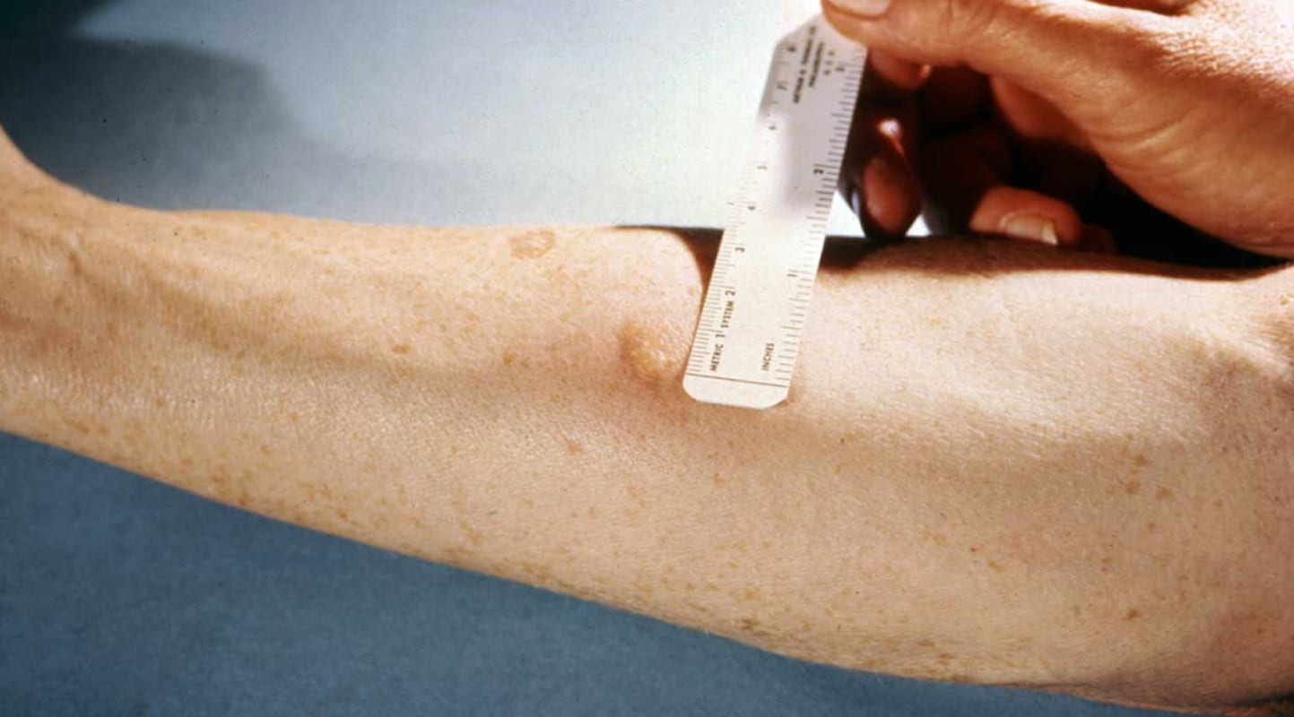 Tuberculin skin test in Edmonton