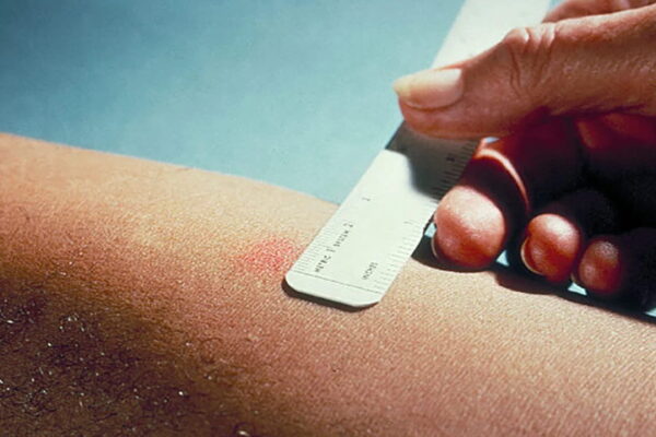 The Importance of Tuberculin Skin Test in Edmonton for Public Health: