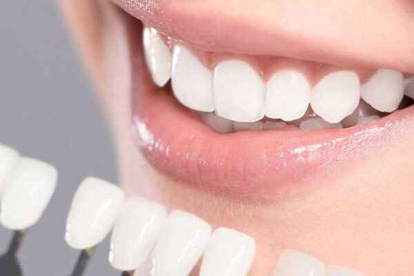 Cosmetic Braces in Victoria: A Key to Opting a Straighter Smile