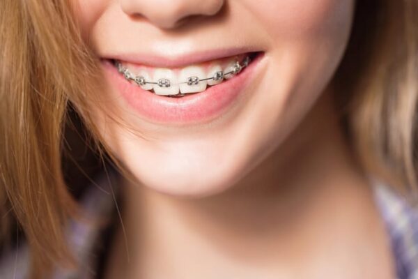 The Functional and Aesthetic Benefits of Adult Braces