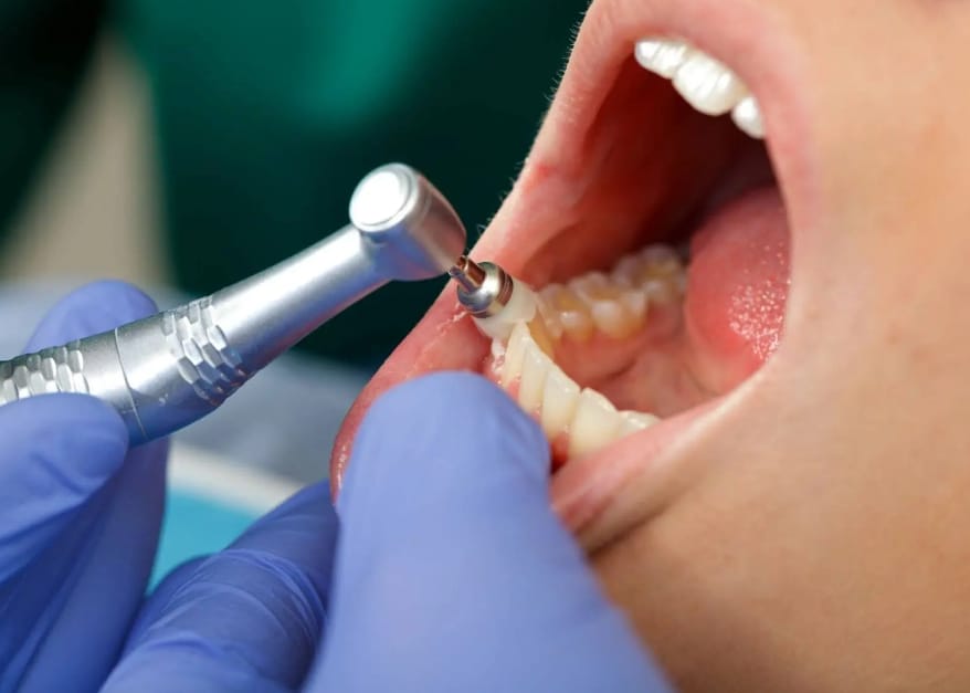 tooth implant infections