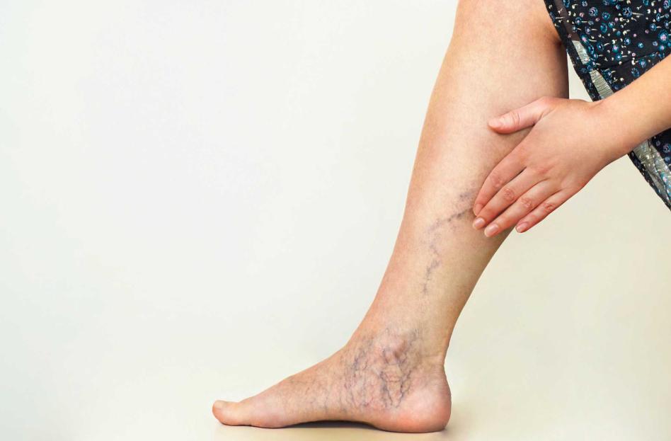 varicose vein injection