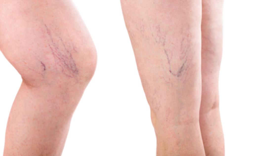 vein injections for varicose veins