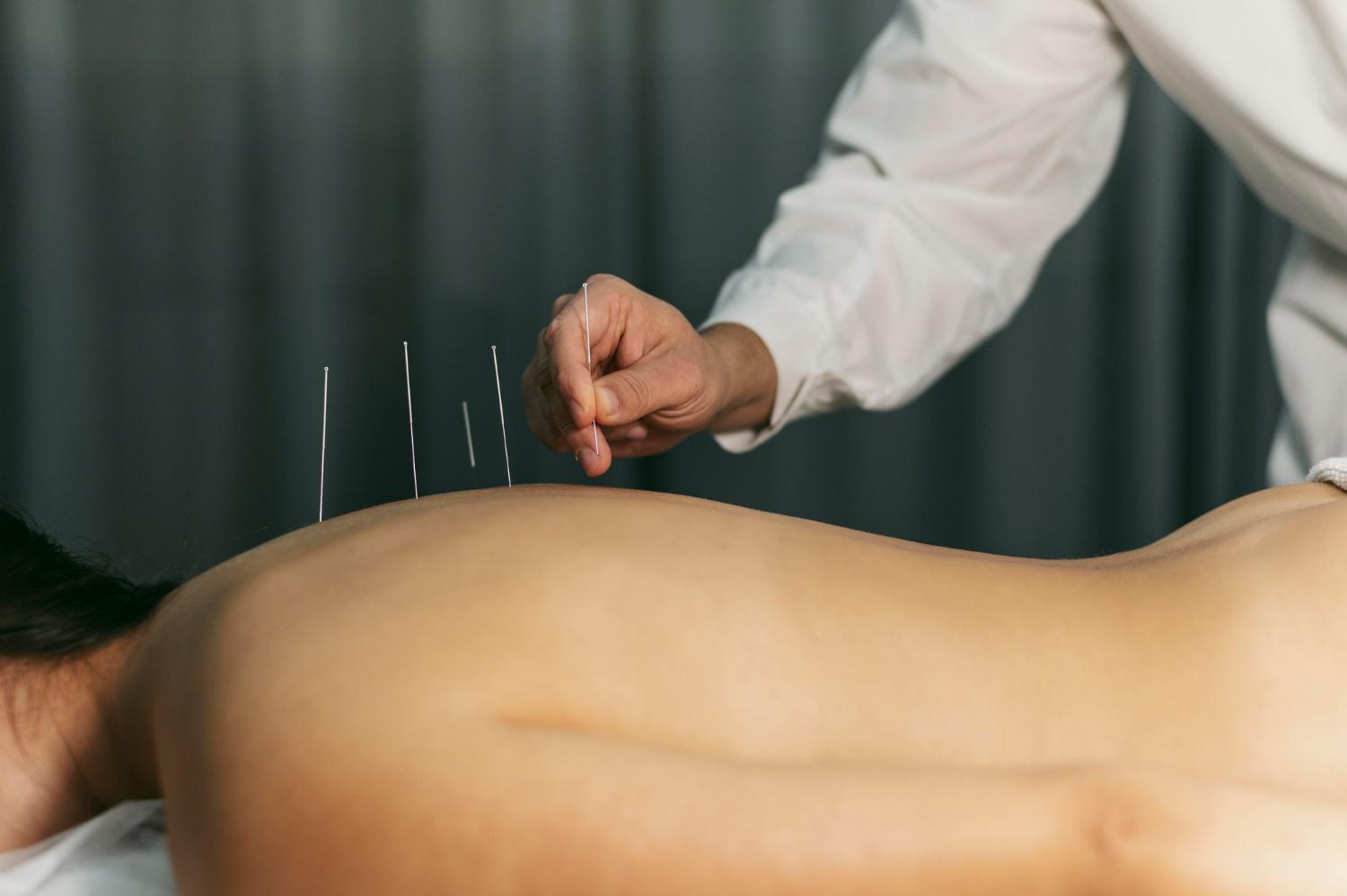 Chinese medicine and acupuncture